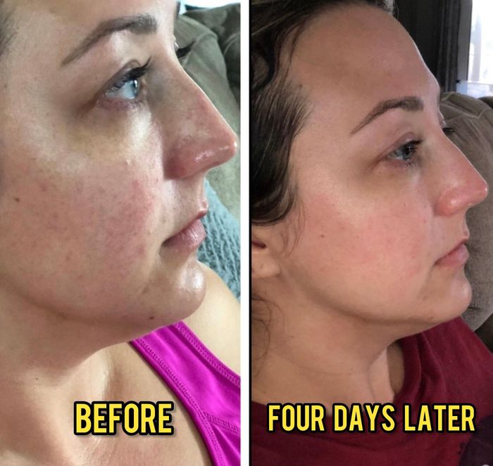A reviewer’s face before and after using the skincare product, showing clear improvements in skin clarity.