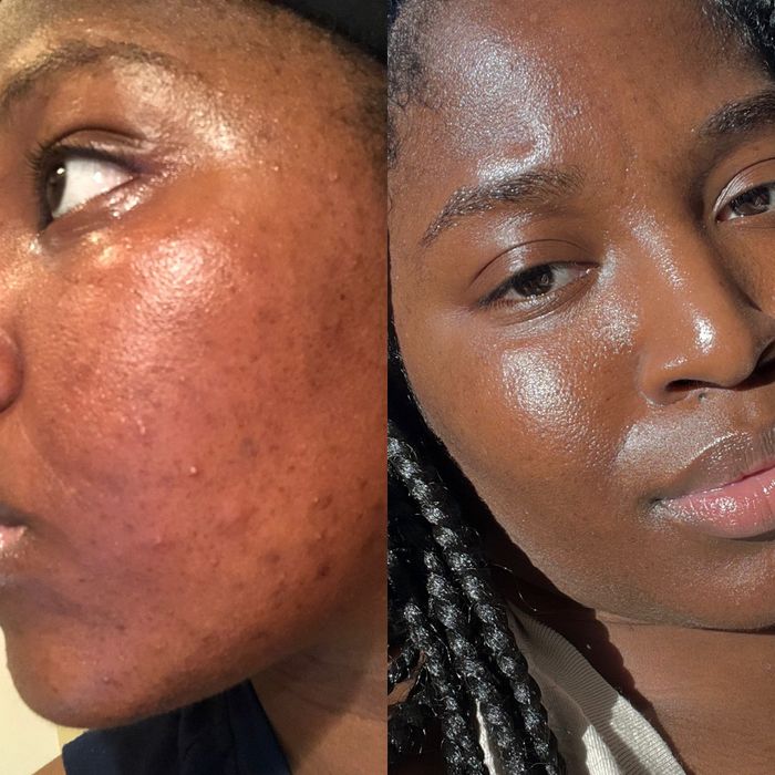 A reader's skin before incorporating regular exfoliants / The same reader's skin after consistently using the product for two years, now clear and smooth.