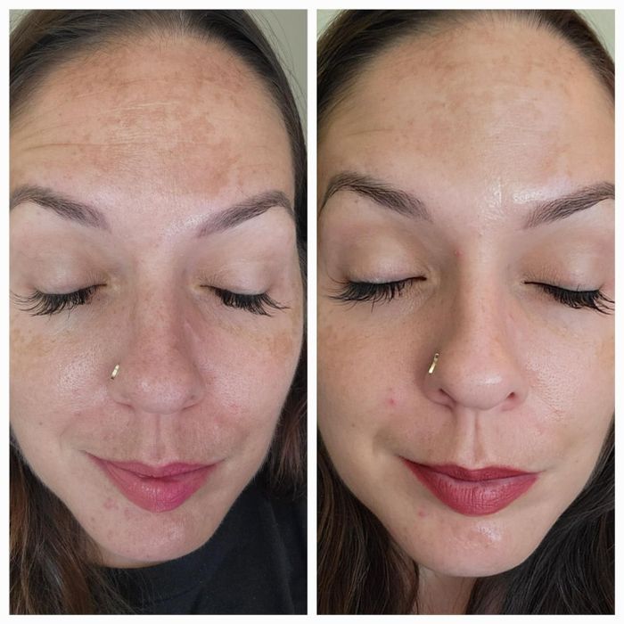 A before-and-after image showcasing the improvement of a woman’s complexion after using a skincare product