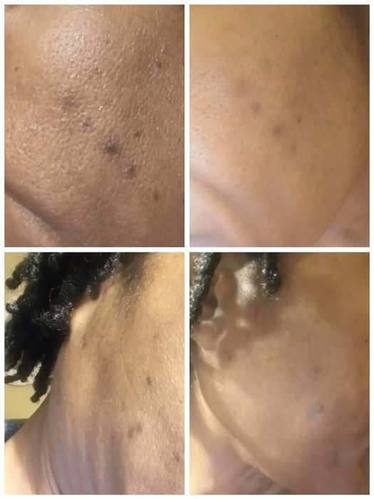 A close-up view of a reviewer's skin showcasing the before and after effects of an acne treatment