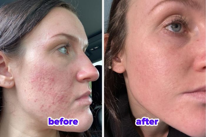 Before and after shots of a reviewer's skin transformation.