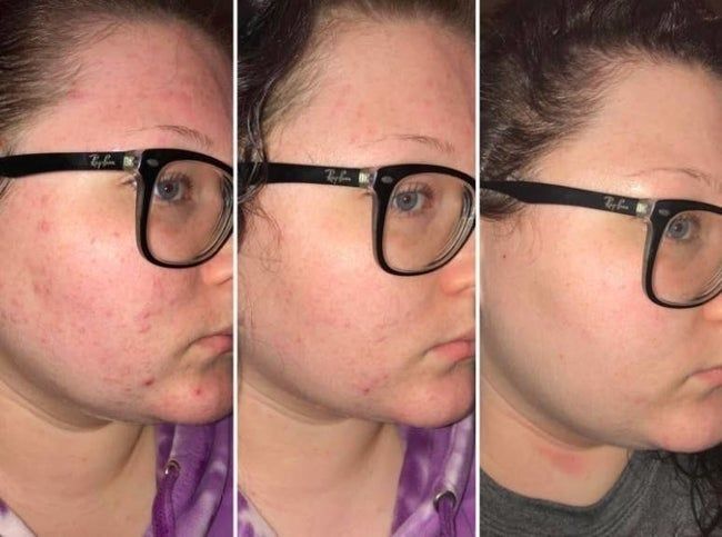 A reviewer’s photo shows a cheek with painful breakouts, followed by the same cheek healing, and eventually clear.