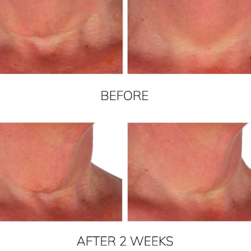 Two side-by-side photos showing visible improvement: loose neck skin tightened and wrinkles significantly reduced after two weeks of use.