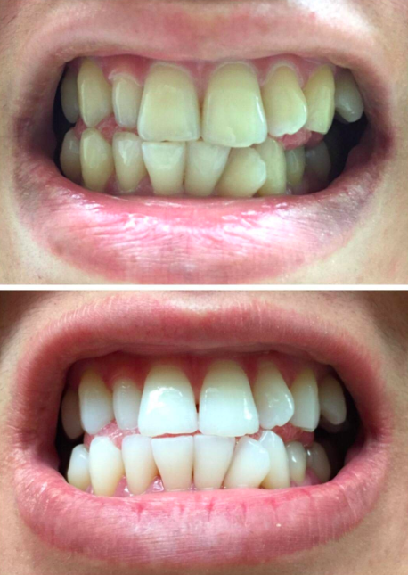 An image comparison showing teeth before and after using the strips to highlight their effectiveness.