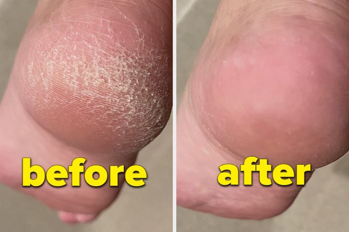 A reviewer's before and after showing their cracked heel, followed by a smooth and healed heel