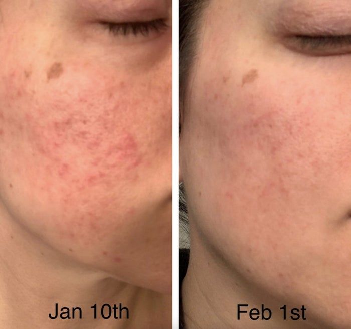 A side-by-side comparison of two cheeks demonstrates noticeable skin improvement from January 10th to February 1st, revealing fewer blemishes and a smoother, more refined texture