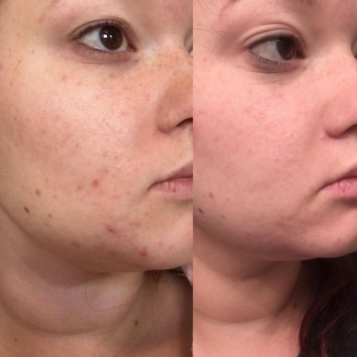 Close-up side-by-side before and after photos of a person’s face demonstrating a noticeable reduction in acne and blemishes