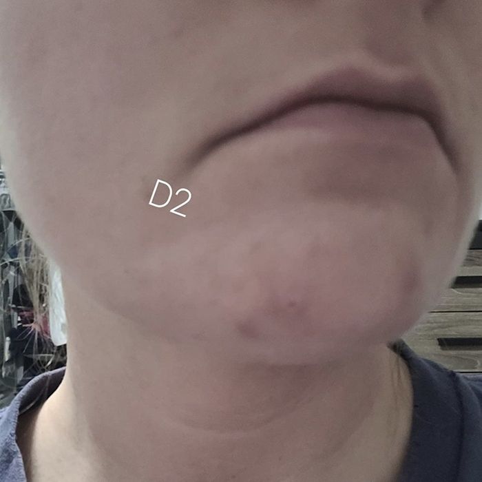 a reviewer's skin showing a reduced pimple after using the balm