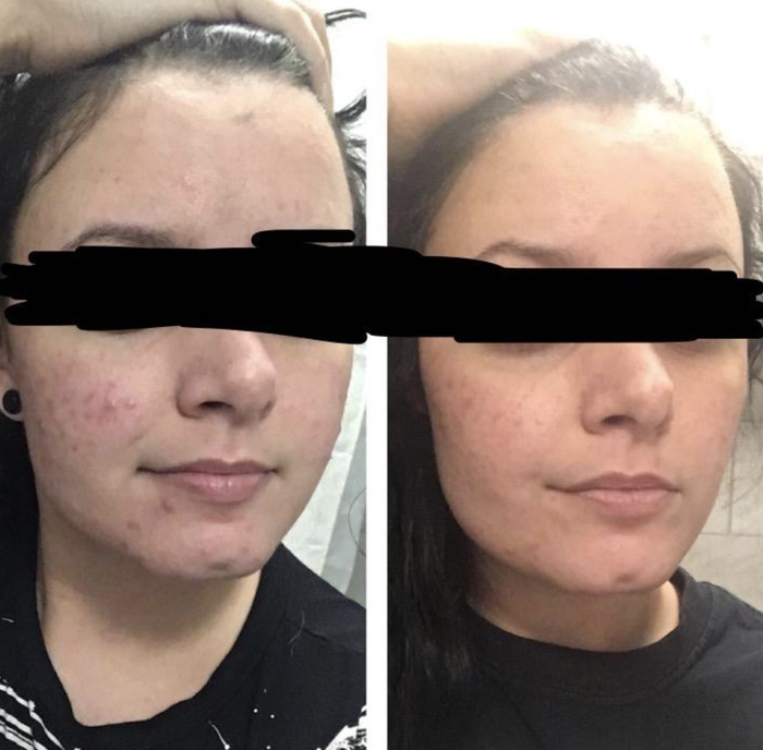 a reviewer showing noticeable acne on the left side and significantly clearer skin on the right