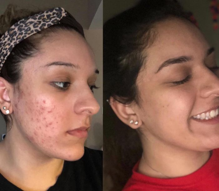 Side-by-side comparison of a person’s face before and after skincare treatment; acne is visible in the before photo, while the after photo shows clear, smooth skin