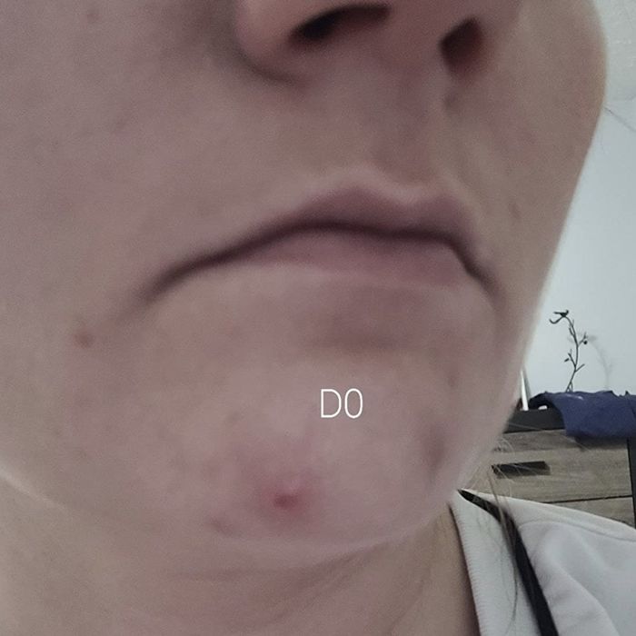 a reviewer's skin with a visible pimple before applying the balm
