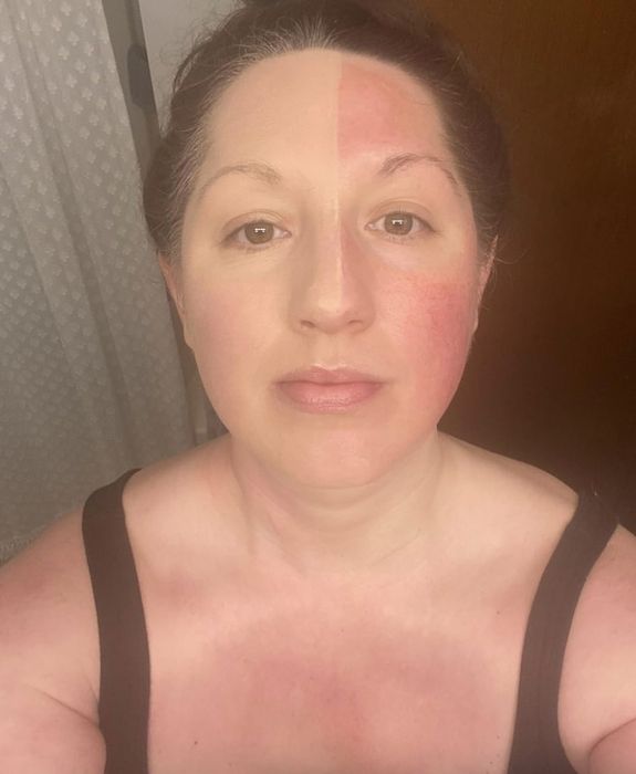 A person with half of their face and neck visibly sunburned, while the other half remains unaffected. They maintain a neutral expression and are dressed in a sleeveless top