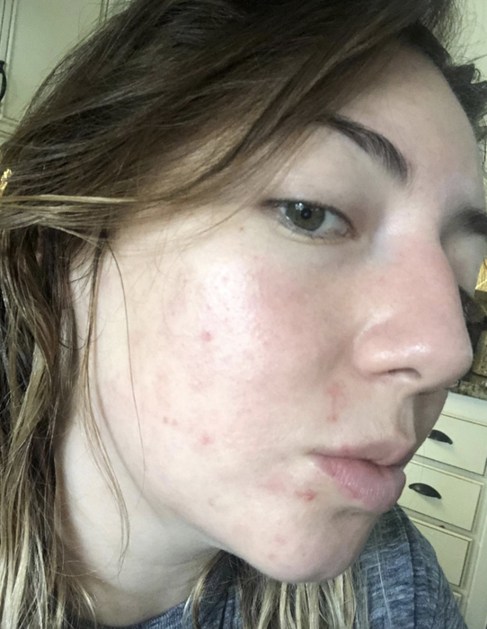 the same reviewer displaying a significant reduction in acne