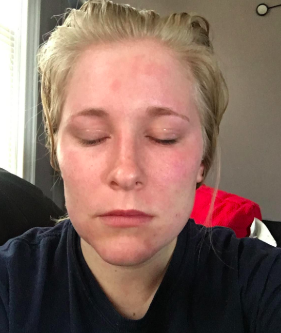 Reviewer's face showing signs of eczema but visibly calmer and more comfortable