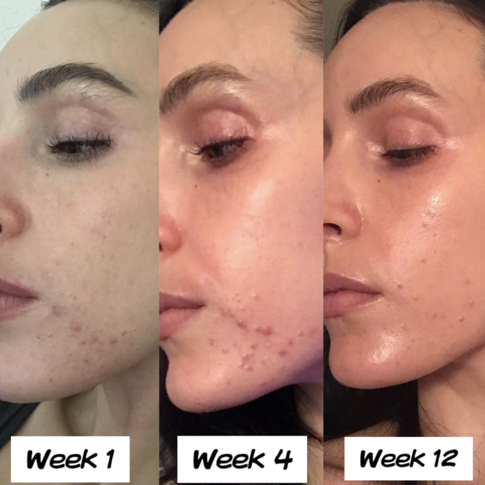 The reviewer demonstrates progress over week 1, week 4, and week 12 using the product, with acne visibly diminishing in each subsequent image.