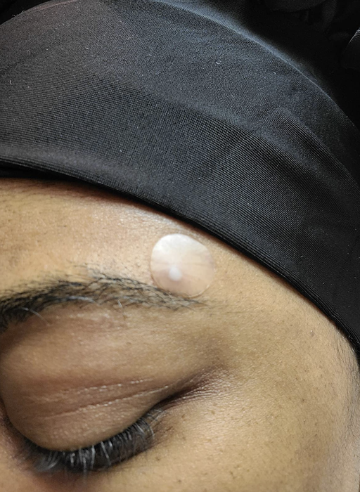 The reviewer is seen wearing an acne patch just above the eyebrow.