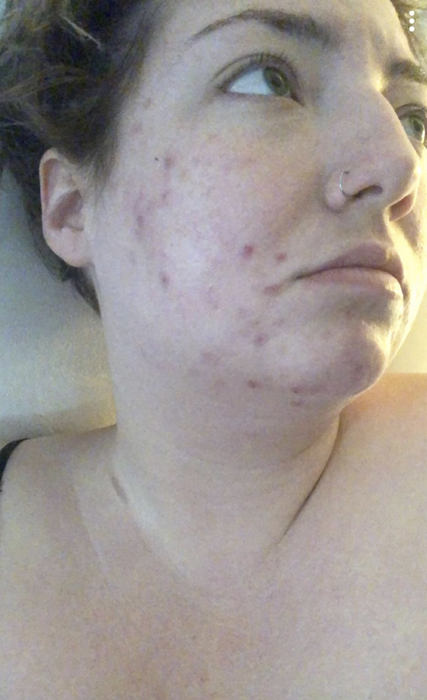 a reviewer showcasing noticeable redness and acne on their skin