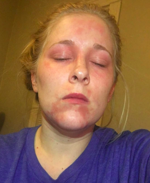 Reviewer's before photo showing eczema