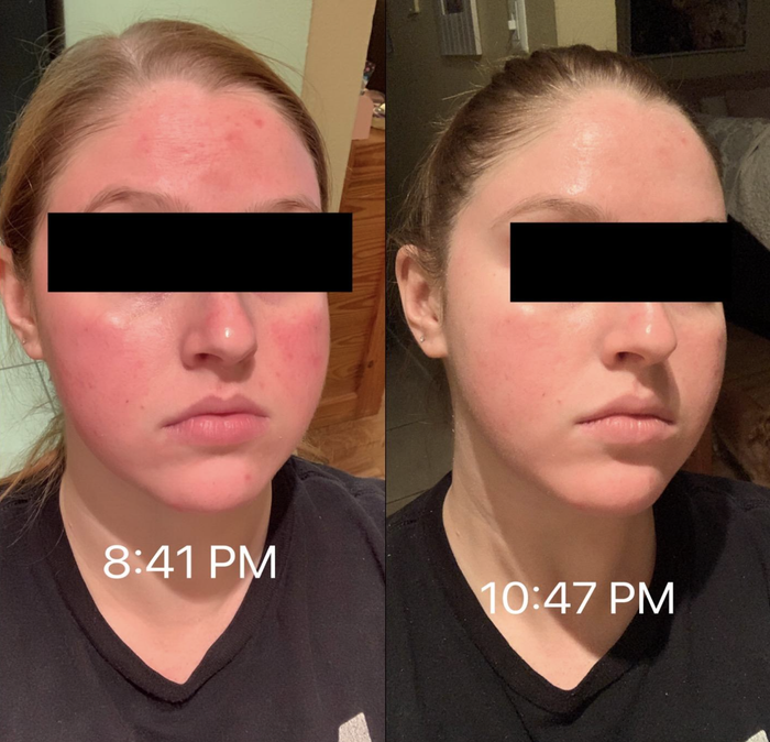 before and after photo of a reviewer: on the left, visibly red skin labeled "8:41pm", and on the right, significantly less red skin labeled "10:47pm"