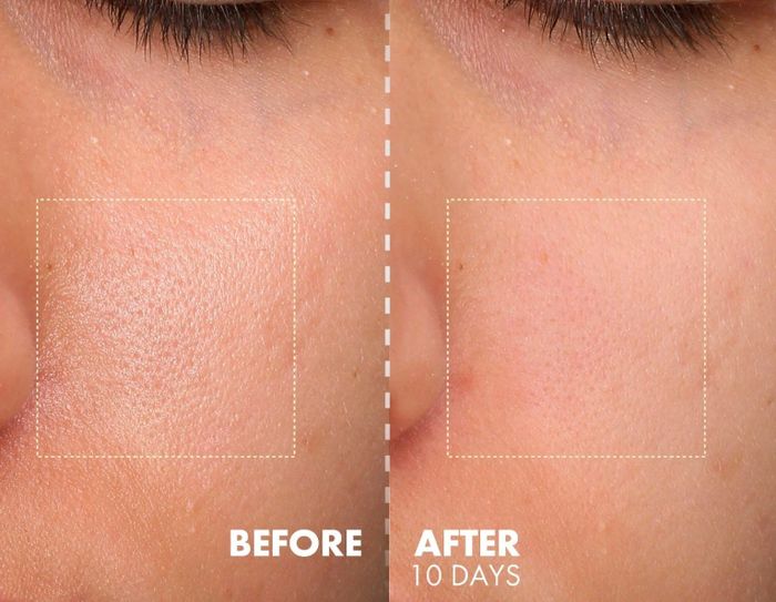 Close-up shot of a person's cheek showing skin texture improvement from 'Before' to 'After 10 days' of using the product.