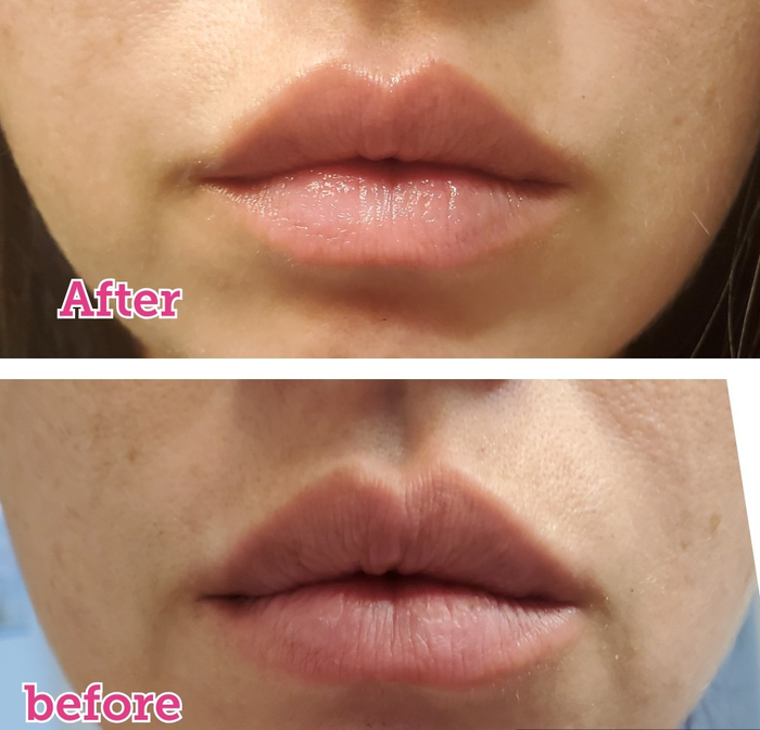 A close-up of a person's lips before and after using a lip-enhancing product, showcasing visibly fuller lips.