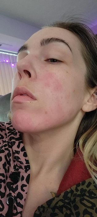 A reviewer showing redness on their face before using the toner.