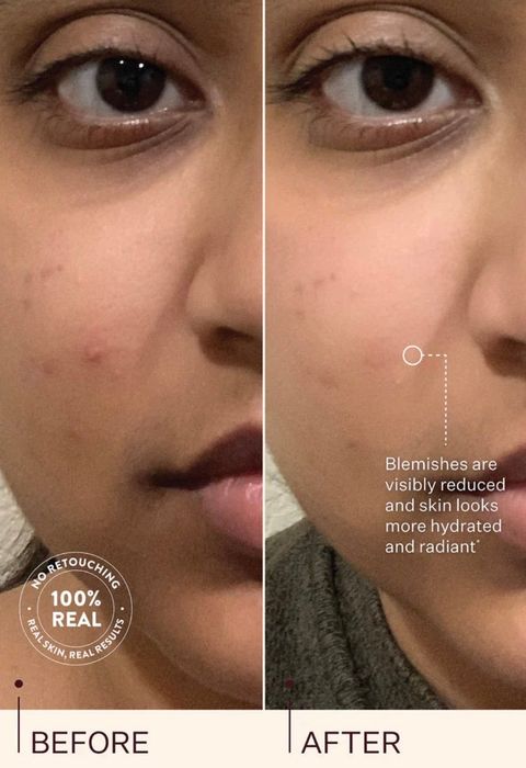 Close-up shot of a person’s face showing a comparison before and after using a skincare product, revealing clearer skin and reduced blemishes.