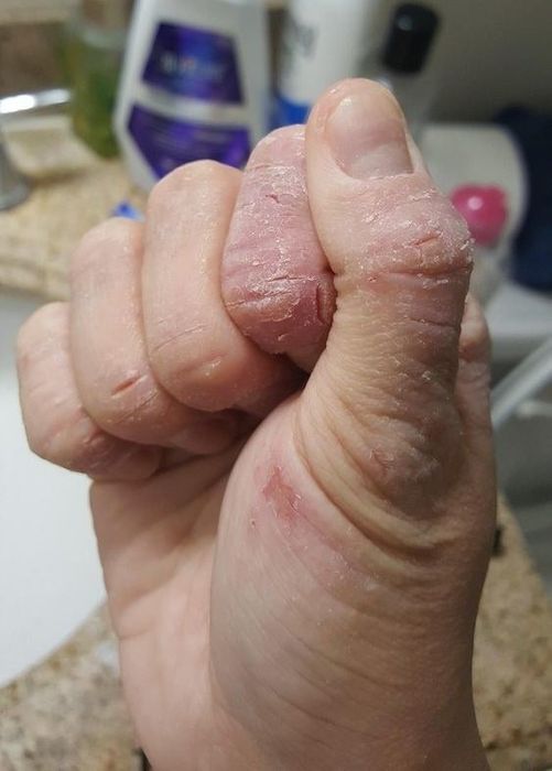 before picture showing a reviewer's cracked hand