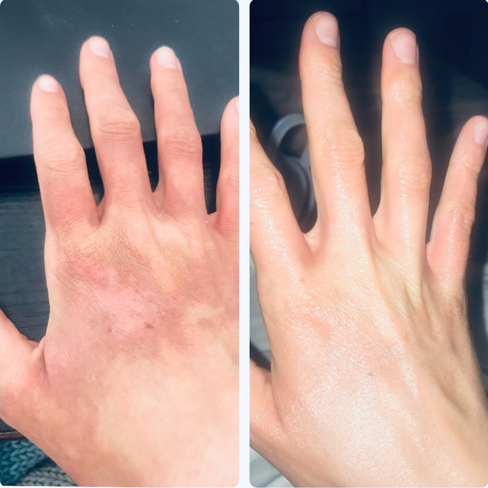 The reviewer with scarring before using the oil, followed by faded scars after application.
