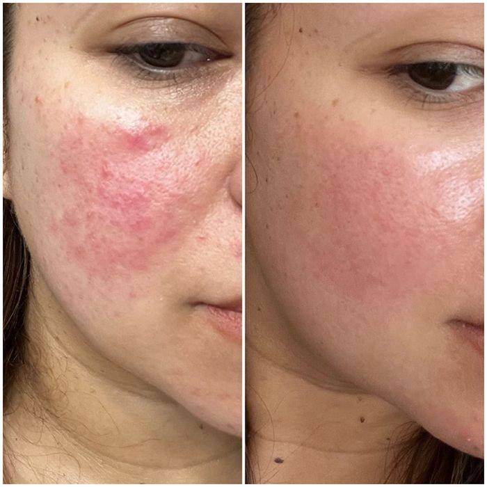 A reviewer shows before-and-after images, with rosacea flare-ups before using the cleanser and clear, smooth skin after applying the product