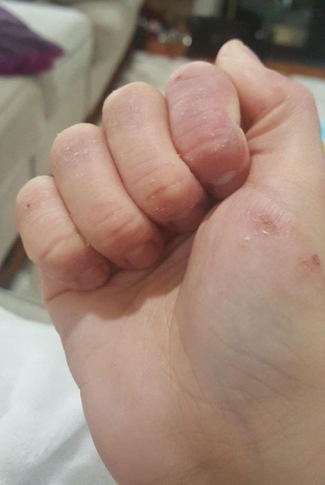 after picture showing the healed hand