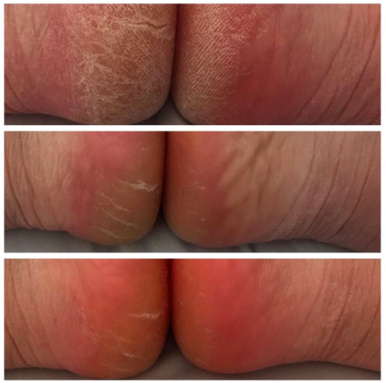 A collection of customer photos showcasing the visible benefits of using the foot cream