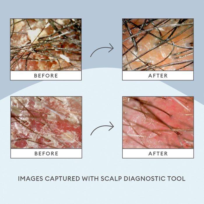 Before and after images showing scalps with dryness and flakes before using the treatment, and the same scalps smooth and flake-free after applying the treatment