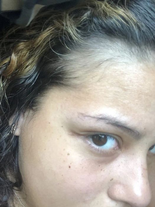 A reviewer showcasing visible hair growth.