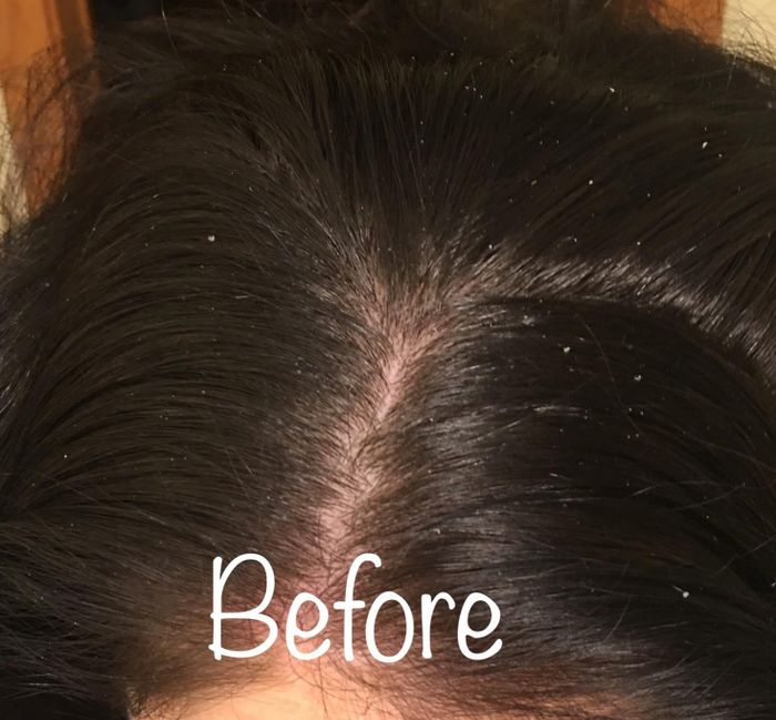 The reviewer's hair before using Nizoral shampoo was plagued with visible flakes and a dry, itchy scalp.