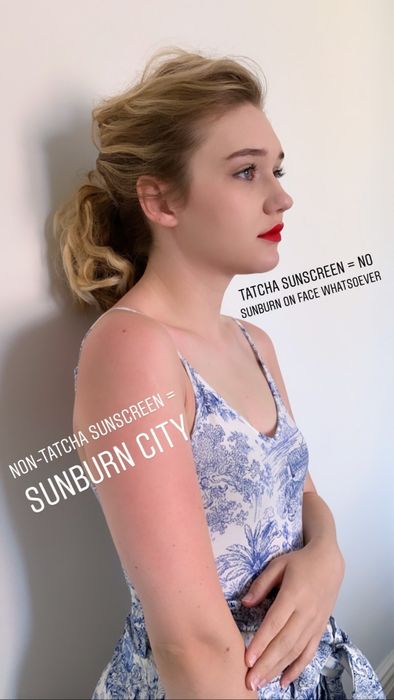 Maitland demonstrating the sunscreen's effect on her face (no sunburn) compared to the body (sunburned).