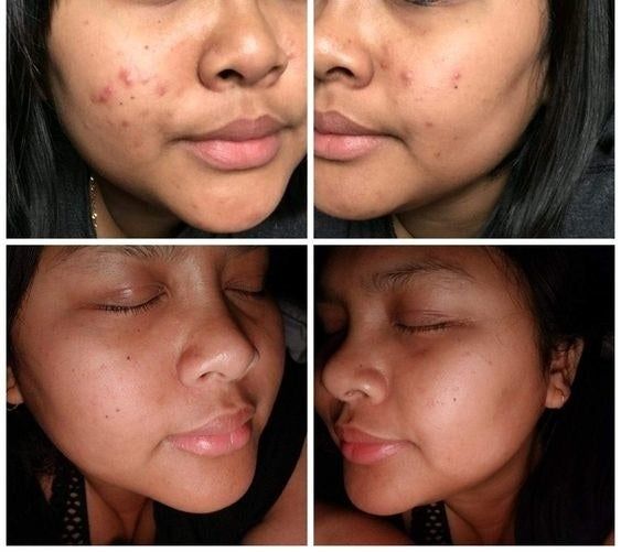 Before and after images from the reviewer showing noticeable reduction in acne scars and smoother skin texture.