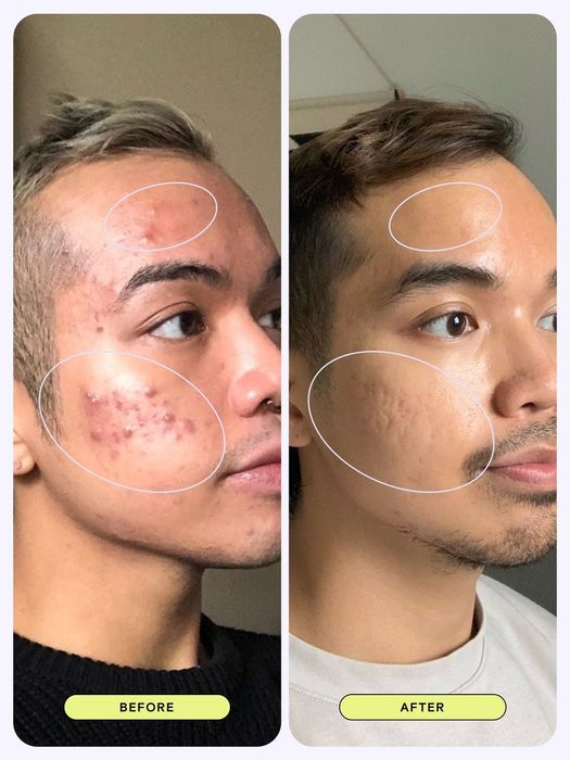Before and after photos showing the improvement in acne after using the cleanser.