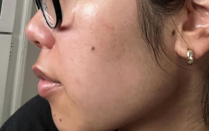 Reviewer’s skin is visibly clearer after using the toner.