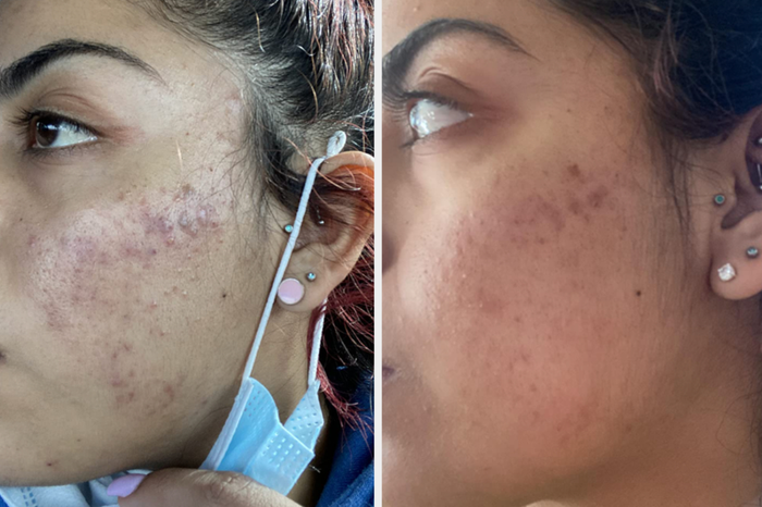 Before and after of a reviewer with irritated skin that cleared up after using the toner.