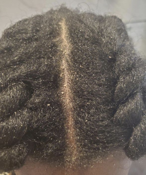 a person struggling with dandruff before applying the shampoo