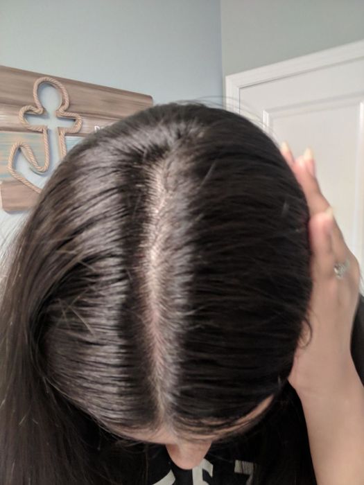 The same reviewer's scalp now appears smooth and glossy, completely free of flakes