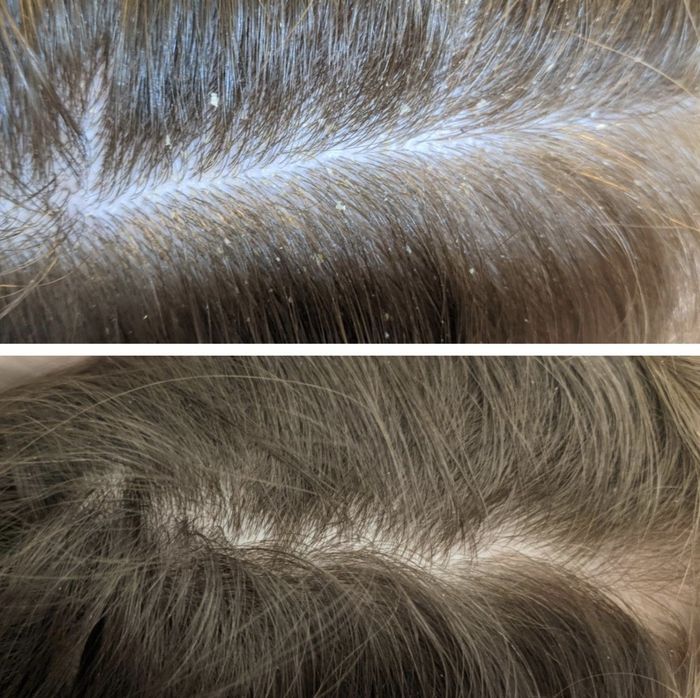 a before and after comparison of a person with and without dandruff