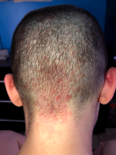 a reviewer’s photo of a scalp showing redness and irritation