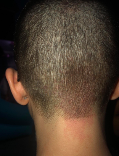 a reviewer’s photo of the scalp looking less red and irritated after using the scalp massager