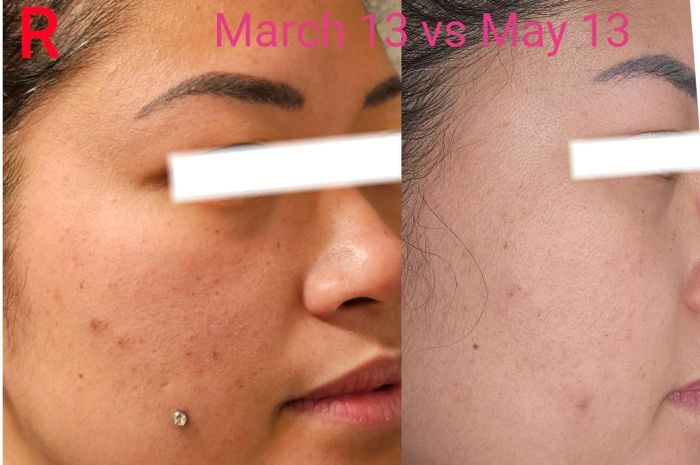 Side-by-side before photos of a reviewer showing clogged pores and acne, followed by clearer skin after use.