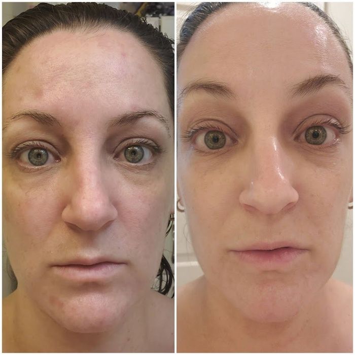 Before-and-after close-up shots of a reviewer’s face, showing a transformation from red and irritated to calm and even-toned.