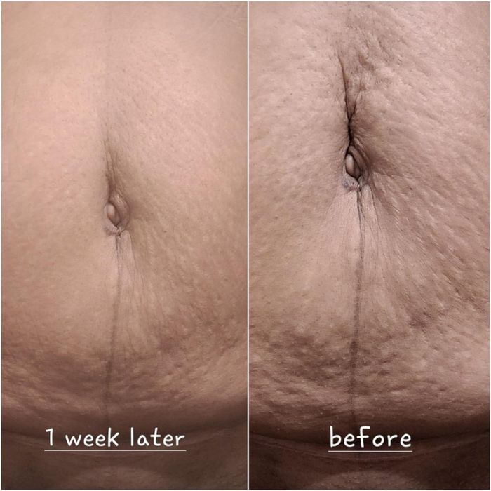 A close-up comparison of a person’s navel area, showing noticeable skin improvement; the left image is labeled.