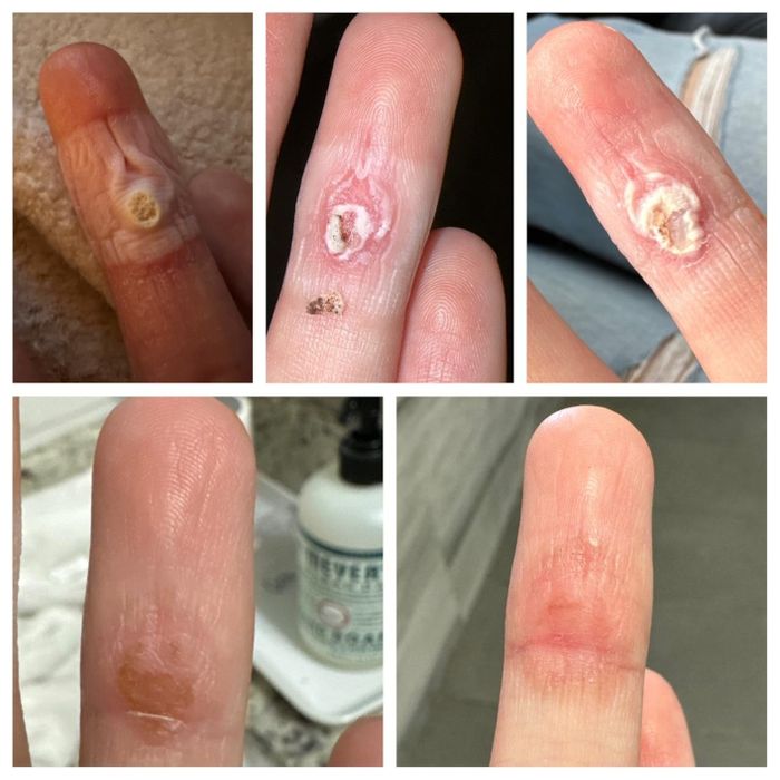 A close-up image showing a finger healing through various stages from a wart.