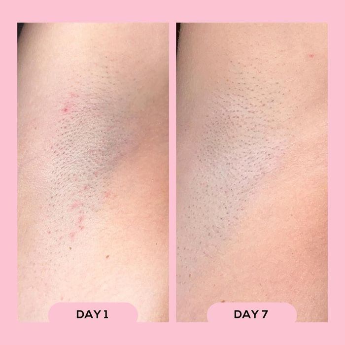 Before and after images of underarms showing a reduction in razor bumps and redness after seven days of use.